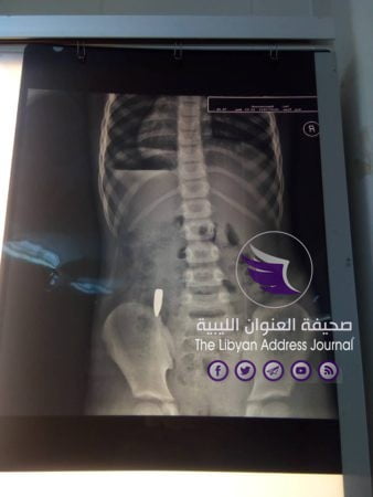 انقاذ حياة طفلة أصيبت برصاص عشوائي في بنغازي 3 انقاذ حياة طفلة أصيبت برصاص عشوائي في بنغازي - 67378563 1129027600617790 2797226725740642304 n