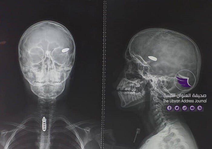 إزالة رصاصة عشوائية من رأس طفل في بنغازي - 128198308 249878926507803 4125294616536055439 n
