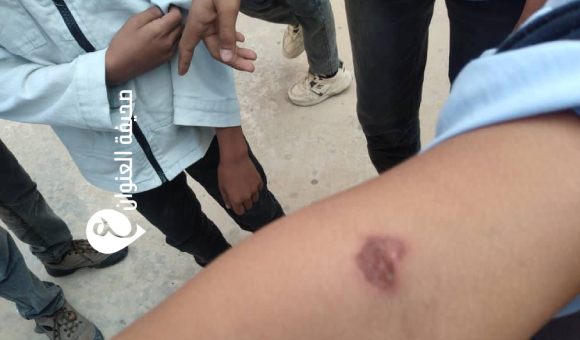 «مكافحة الأمراض»: لا زيادة في إصابات اللشمانيا بترهونة - psd elenwan 20